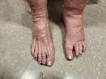 Lymphedema